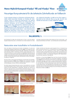 Nano-Hybrid-Komposit Visalys® Fill und Visalys® Flow