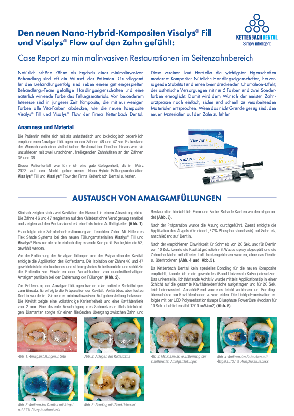 Den neuen Nano-Hybrid-Kompositen Visalys® Fill und Visalys® Flow auf den Zahn gefühlt