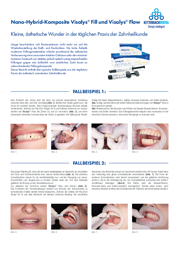 Nano-Hybrid-Komposite Visalys® Fill und Visalys® Flow