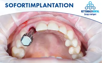 Abgedeckter Mundraum mit vorbereiteter Implantation