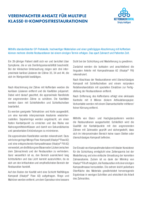 Vereinfachter Ansatz für multiple Klasse-II-Kompositrestaurationen