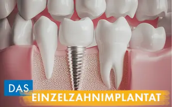 Das Einzelimplantat