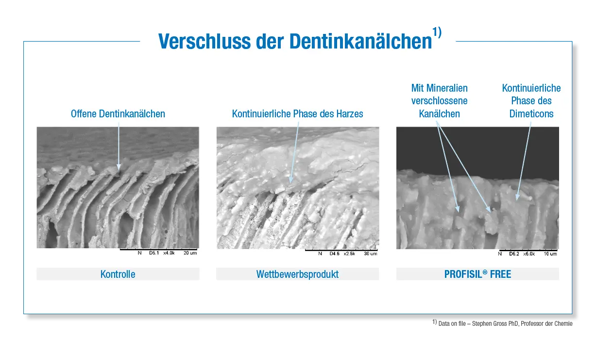 Verschluss der Dentinkanälchen